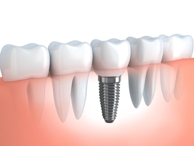 Dental Implants American Canyon, CA 